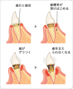 歯周病治療
